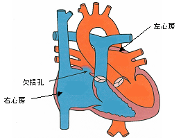 心房中隔欠損症の心臓