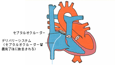 本商品を用いた治療の模式図