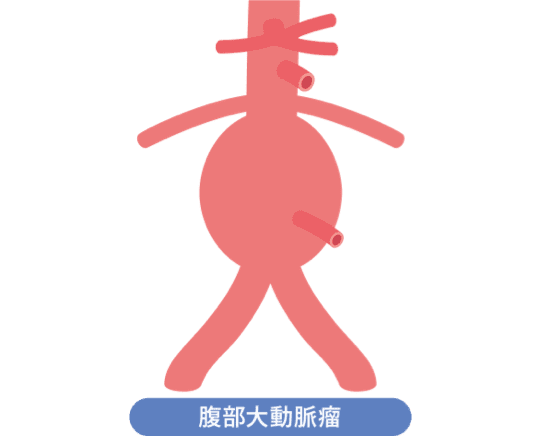 腹部大動脈瘤