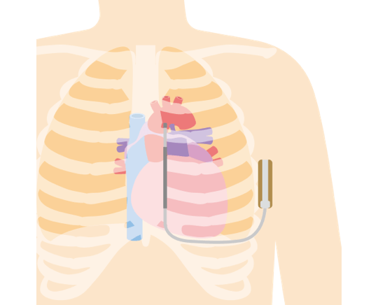 TV-ICD