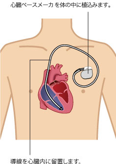 心臓ペースメーカーを体の中に植込みます。 導線を心臓内に留置します