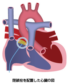 閉鎖栓を配置した心臓の図