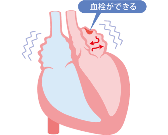 心房細動