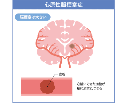 心原性脳塞栓症