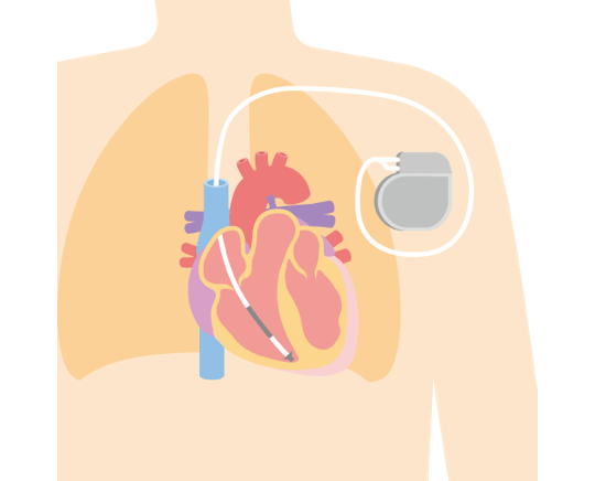 S-ICD