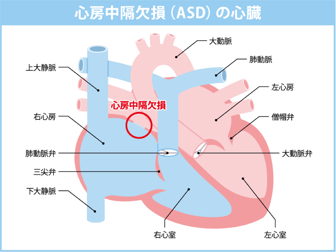 心房中隔欠損(ASD)